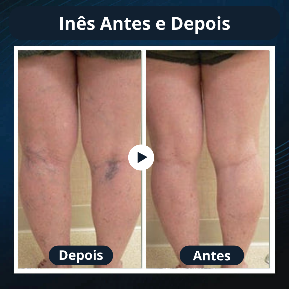 Seurico™: Reduza as Varizes e Restaure a Beleza das Suas Pernas em Apenas Algumas Semanas!