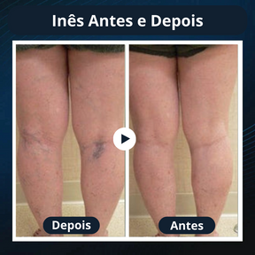 Seurico™: Reduza as Varizes e Restaure a Beleza das Suas Pernas em Apenas Algumas Semanas!