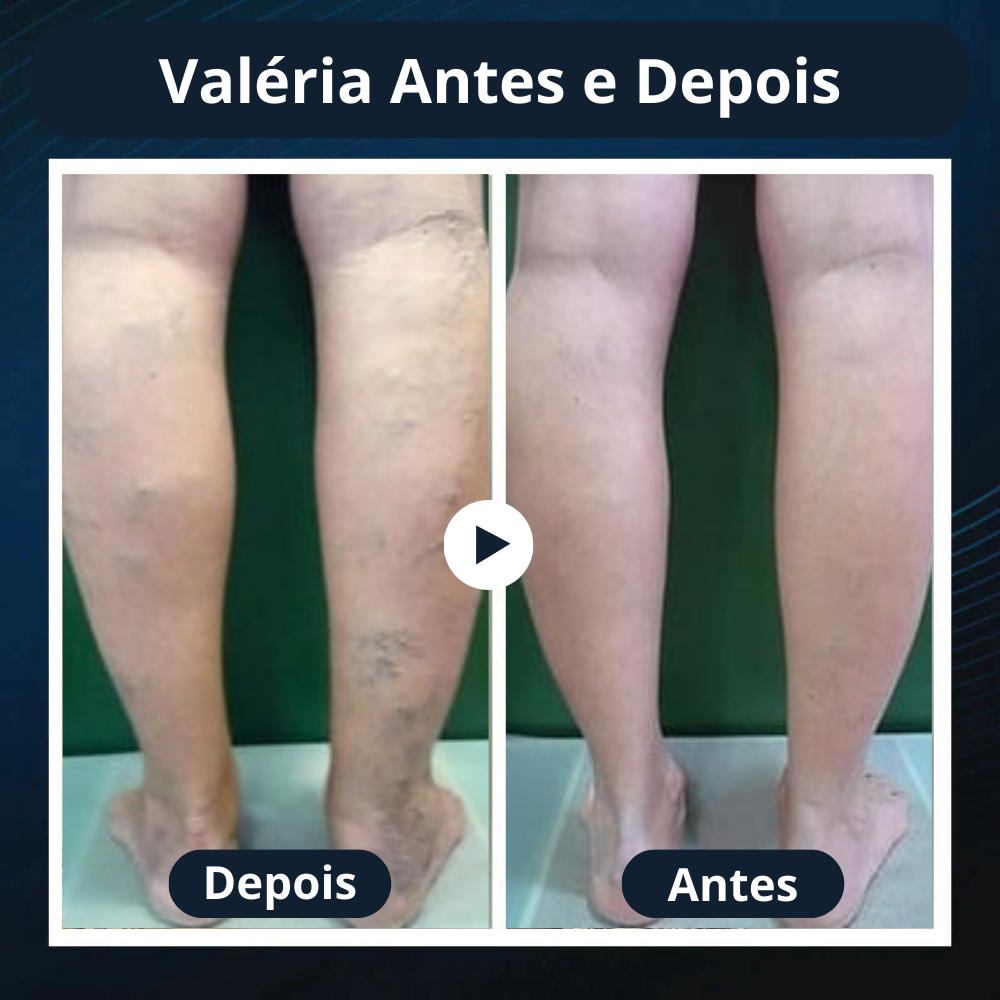 Seurico™: Reduza as Varizes e Restaure a Beleza das Suas Pernas em Apenas Algumas Semanas!